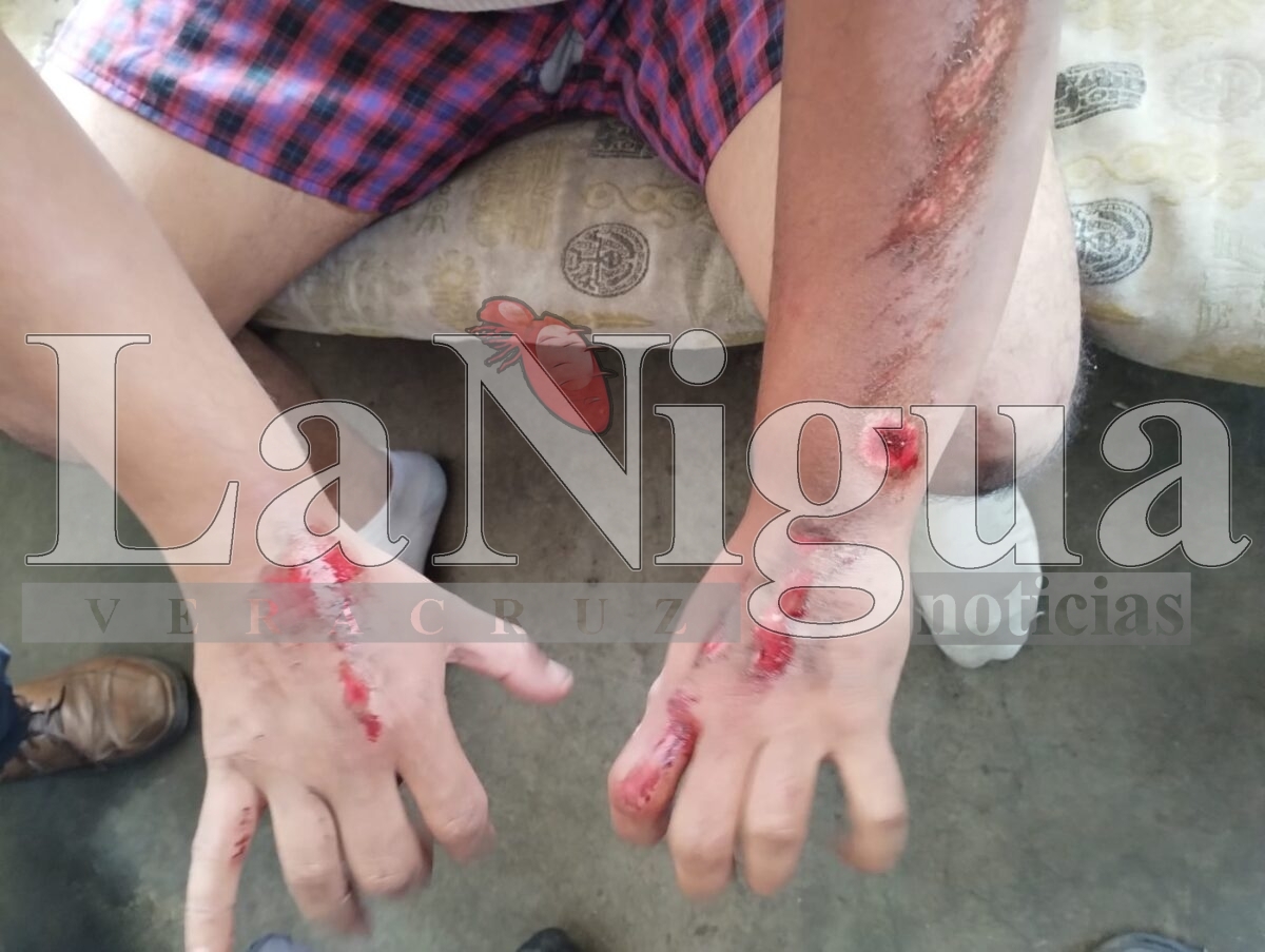 Motociclista Sufre Accidente en Calzada Morelos debido a Baches