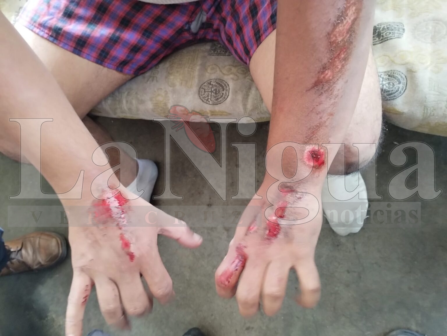 Motociclista Sufre Accidente en Calzada Morelos debido a Baches