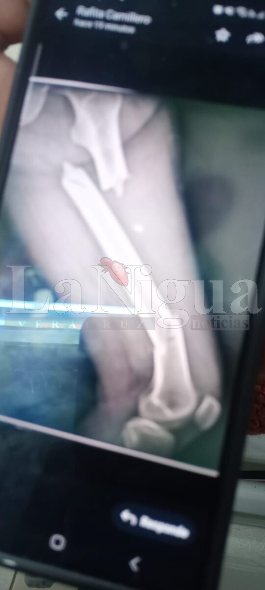 Būfala cimarrona lo ataca y le fractura una pierna y una costilla en Playa Vicente 1 img 20250424 wa01321587427038395647474