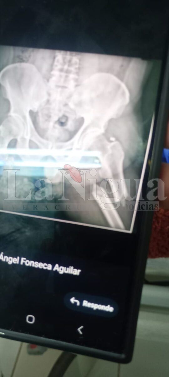 Būfala cimarrona lo ataca y le fractura una pierna y una costilla en Playa Vicente 2 img 20250424 wa01331402668765666990671