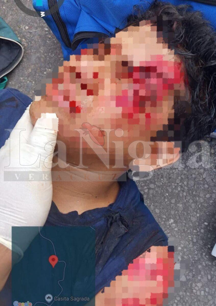 Por no traer casco, joven se destroza la cara en Nuevo Ixcatlán