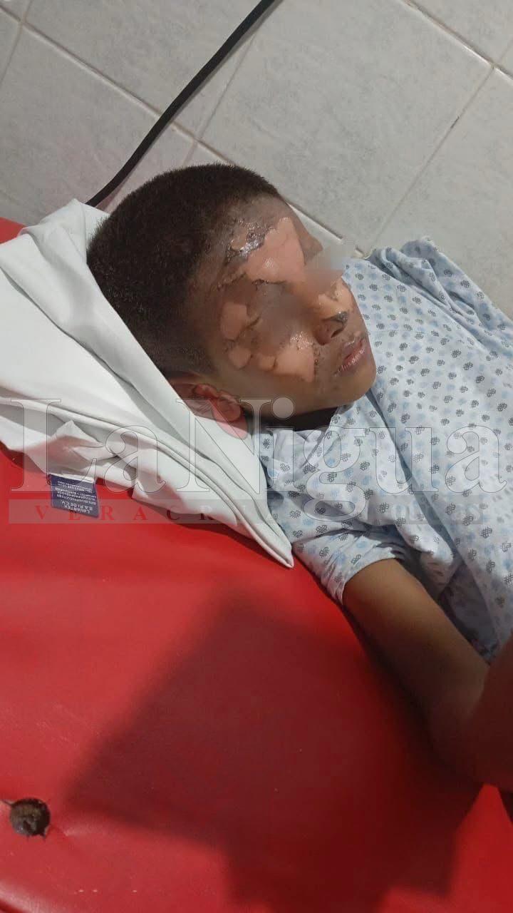 Explosión de encendedor deja a niño con quemaduras graves en Acayucan; familia pide apoyo urgente.