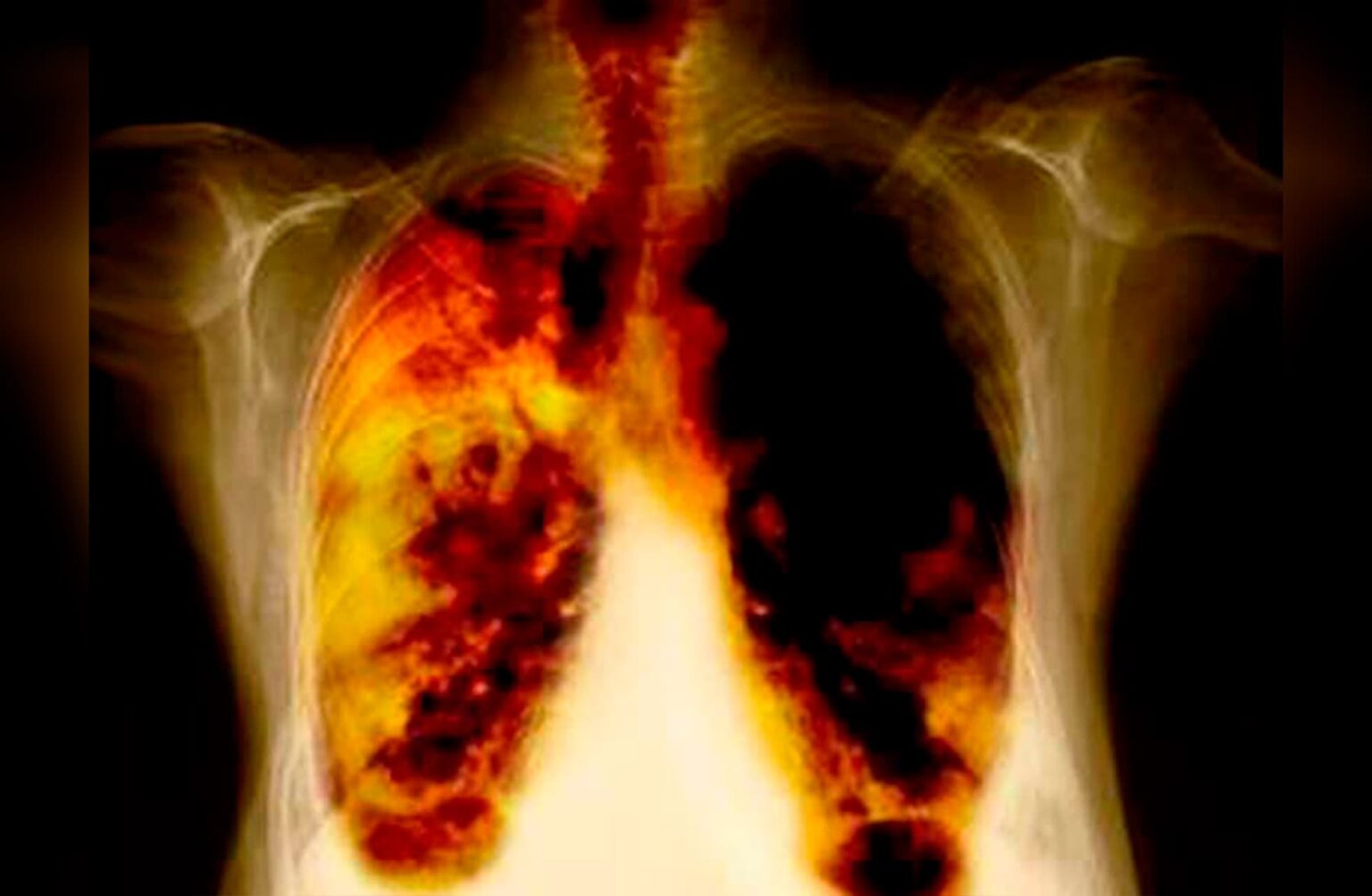 Descubren ‘el talón de Aquiles’ del cáncer de pulmón