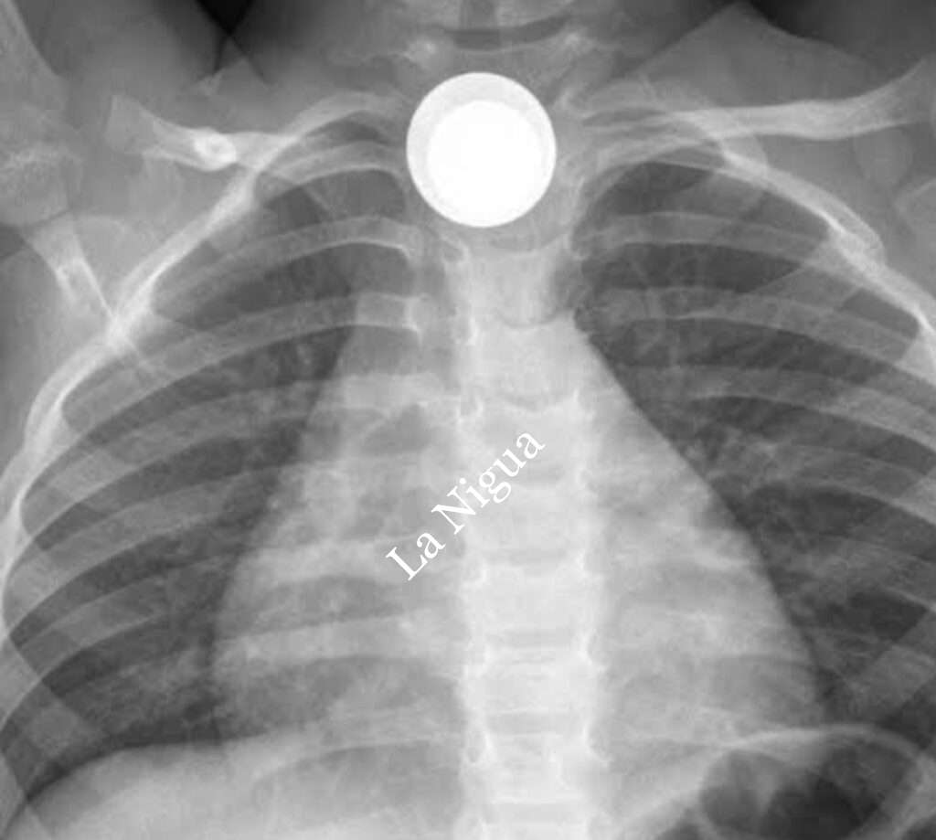 Grave menor de 3 años que se tragó una moneda