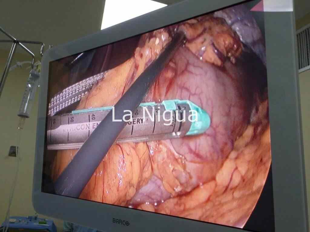 Especialistas del IMSS en Veracruz realizaron con éxito la primera gastrectomía oncológica laparoscópica a paciente con COVID-19 1 img 20220121 wa00254522815185863837032