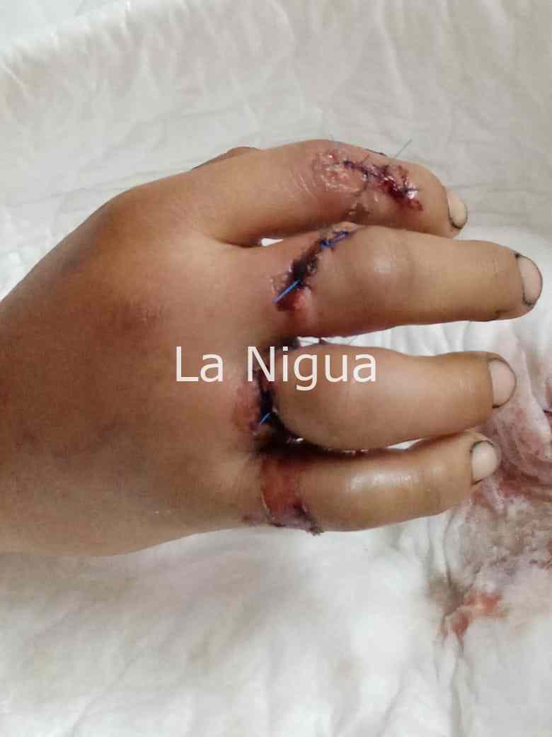 Piden apoyo de alcalde de Xalapa para joven que necesita cirugía en su mano 2 img 20220202 wa00074953243896358002028