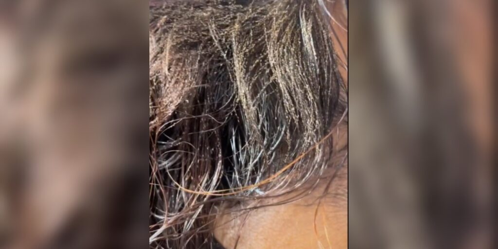 Niña de 9 años fallece por infección grave de piojos en EU